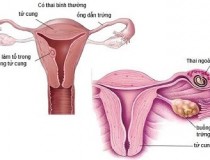 Viêm lộ tuyến cổ tử cung là gì? Các triệu chứng và cách điều trị