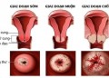 Viêm lộ tuyến cổ tử cung có nguy hiểm không - bệnh phụ khoa